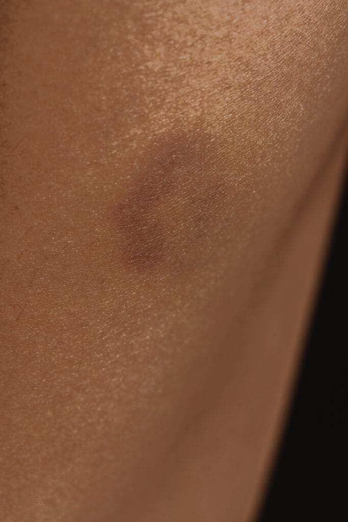 Brown Spots On Legs